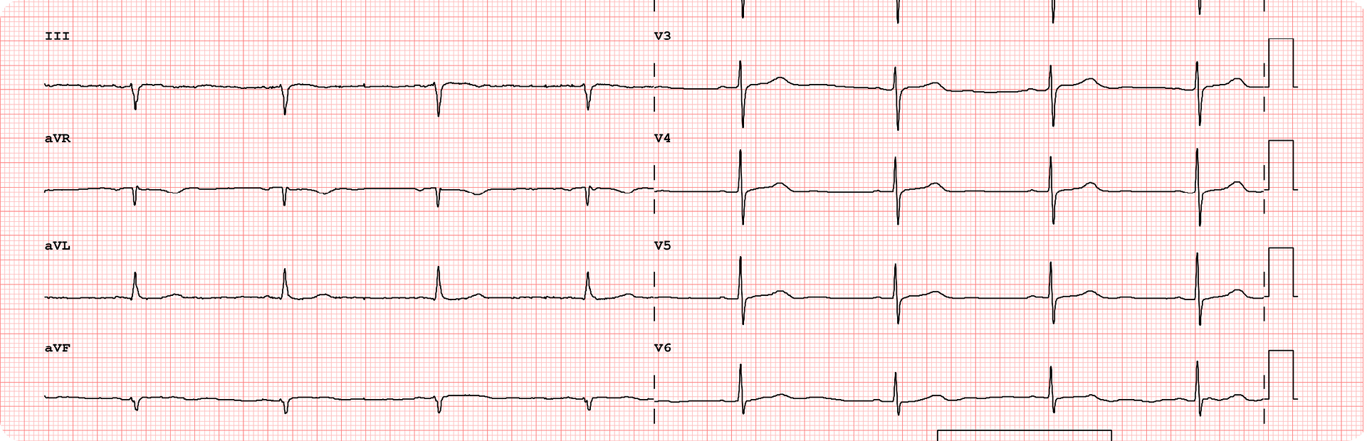 Bradycardia With A Pulse Algorithm